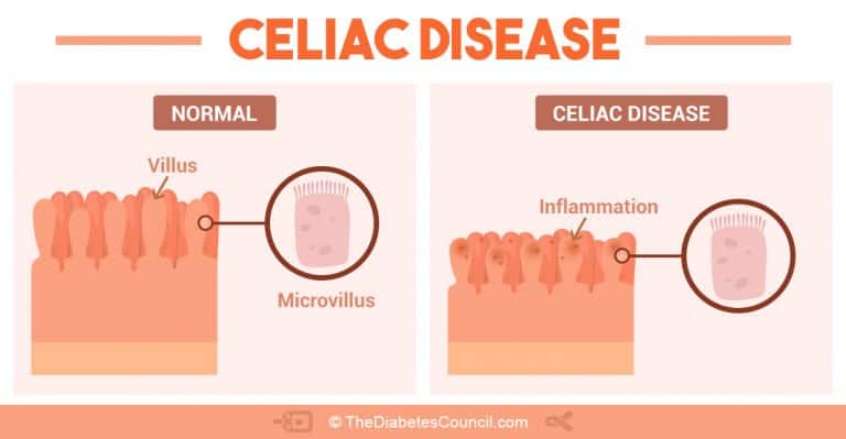 Balancing Diabetes And Celiac Disease