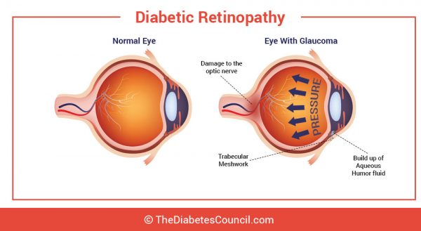 Glaucoma And Diabetes: Can Diabetes Affect Your Eyes?